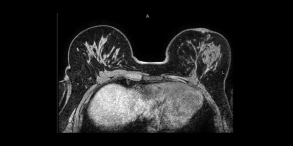 乳房MRI