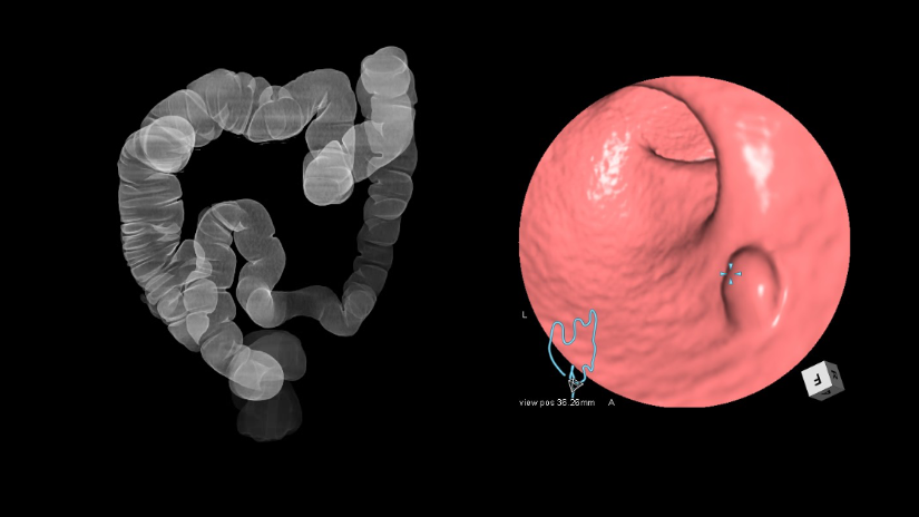 大腸CT、仮想内視鏡