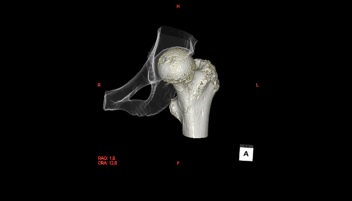 骨・関節CT画像