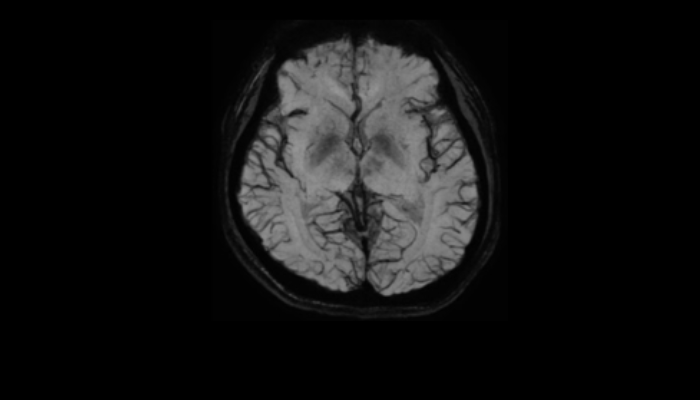 頭部MRI画像