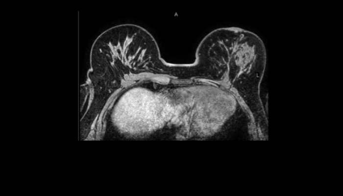 乳房MRI画像