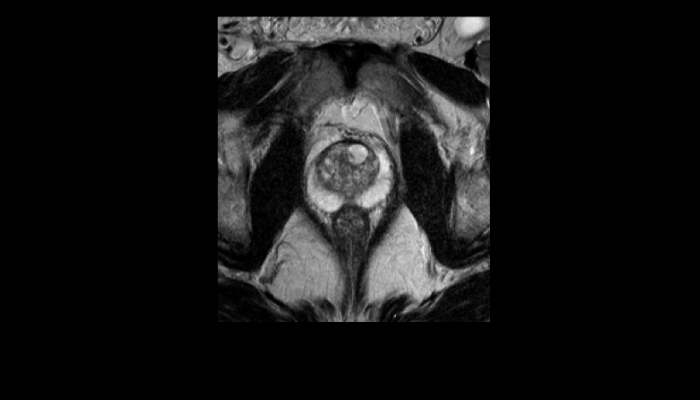 前立腺MRI画像