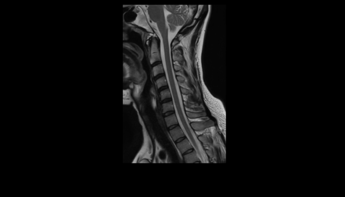 脊椎MRI画像