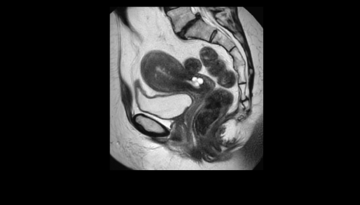 子宮・卵巣MRI画像