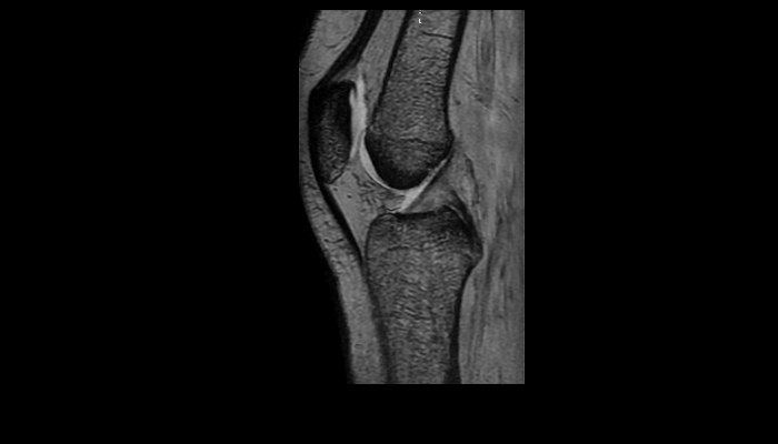 膝関節MRI画像