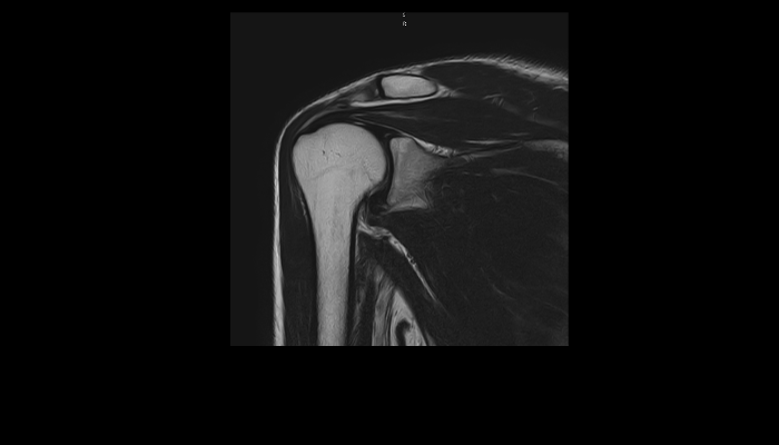 肩関節MRI画像