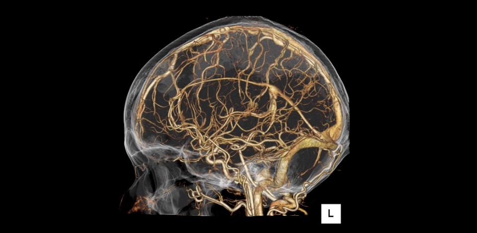 脳血管造影CT