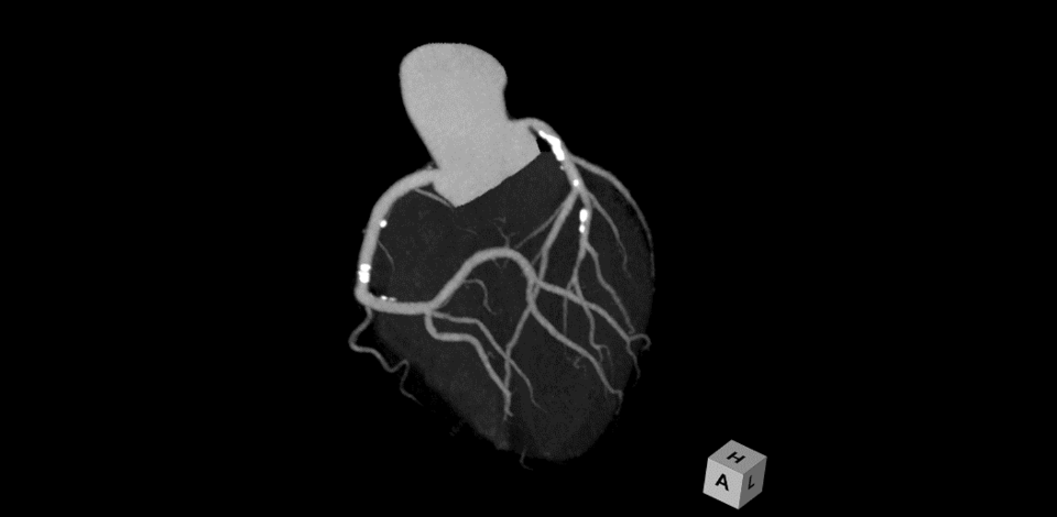 心臓CT